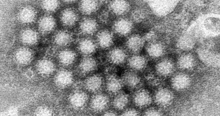 Norovirus is surging in the U.S. this winter compared to past years: CDC – National